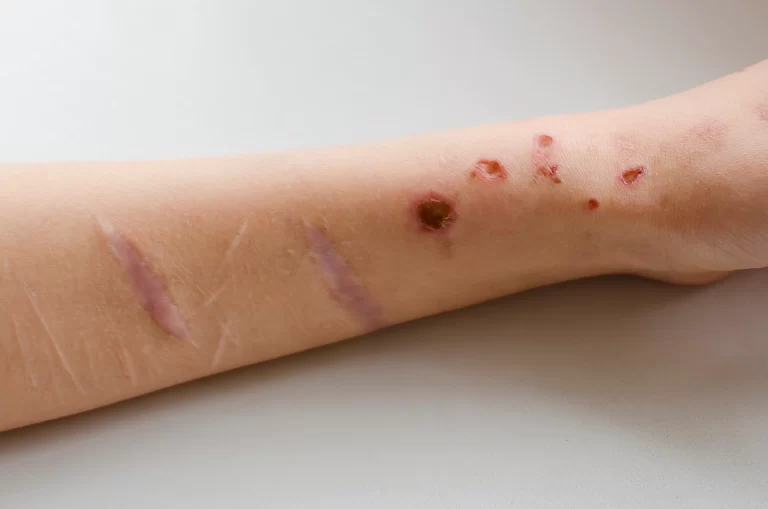 Özünə Zərər Vermə Davranışlarını Anlamaq